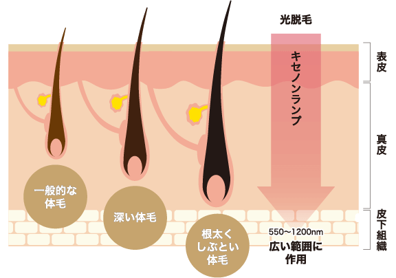 光脱毛